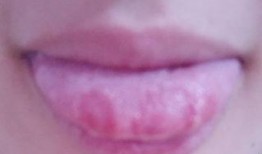 吃瓜吃的舌头疼缓解方法,吃瓜过度舌头疼的缓解攻略