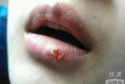 吃瓜嘴角发红,嘴角红润的秘密