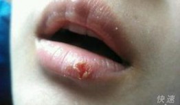 吃瓜嘴角发红,嘴角红润的秘密