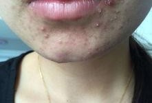 吃瓜吃的嘴角起痘